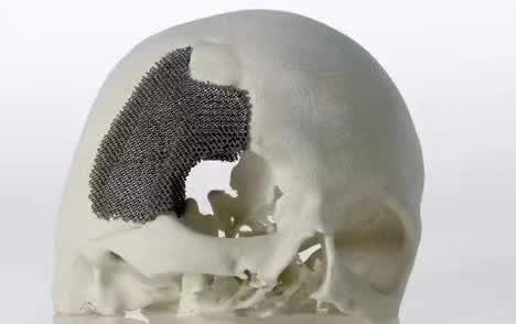 颅骨3D打印技术是什么？